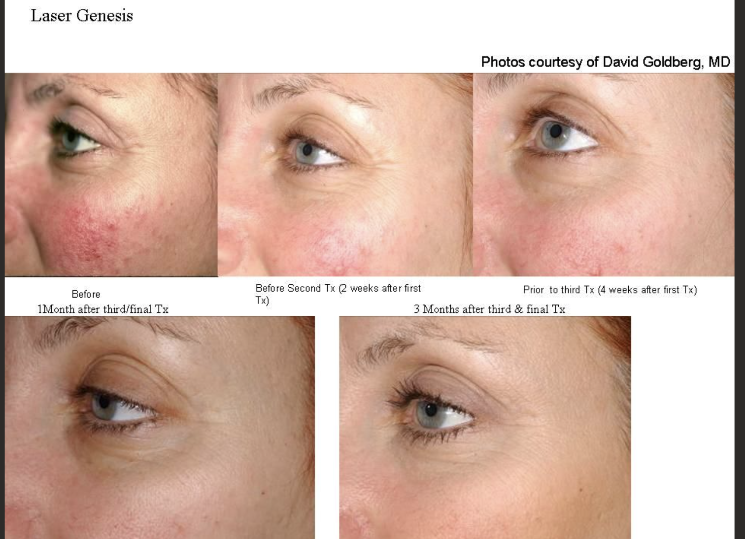 Laser Genesis before and after progression on a client's cheek across three treatments