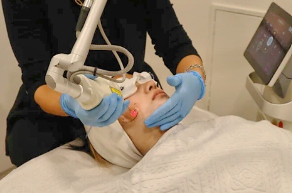 Fractional CO₂ laser treatment being performed on a client at Facelove Medispa